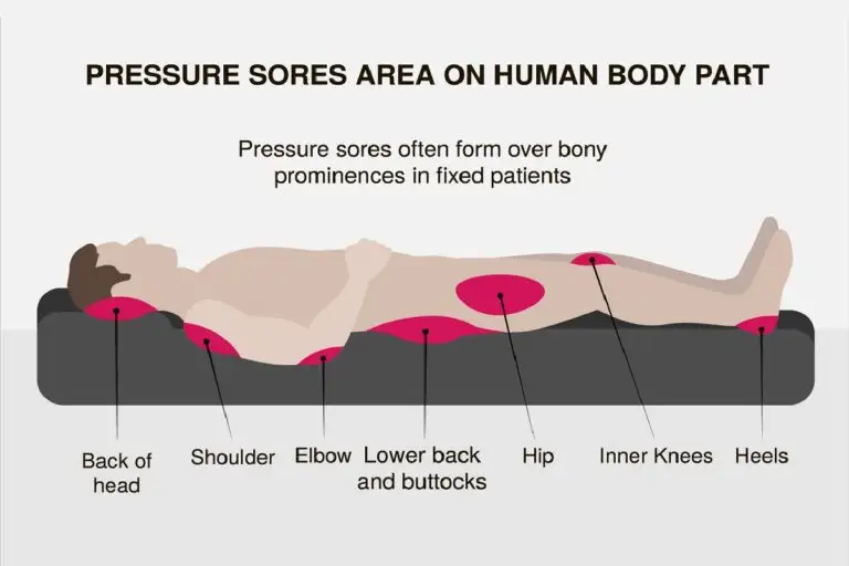 Bed Sores Diagram